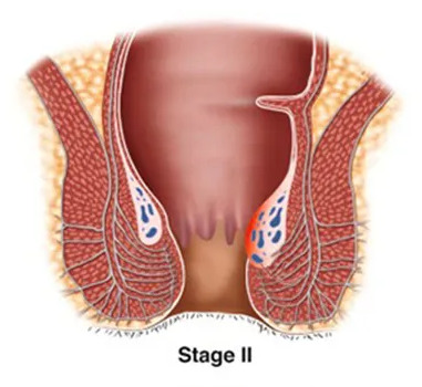 obat ambeien - obat ambeien luar - obat ambeien dalam - obat ambeien paling ampuh - cara mengobati ambeien - cara mengatasi ambeien - cara mengobati ambeien luar - obat ampuh ambeien - obat ambeien alami dan tradisional - obat alami ambeien menonjol - obat herbal ambeien - obat untuk ambeien pada ibu hamil - obat ambeien setelah melahirkan - obat ambeien tanpa operasi - obat ambeien alami yang ampuh - pengobatan ambeien dan penyakit wasir