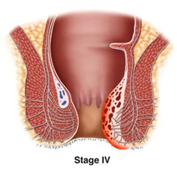 obat ambeien - obat ambeien luar - obat ambeien dalam - obat ambeien paling ampuh - cara mengobati ambeien - cara mengatasi ambeien - cara mengobati ambeien luar - obat ampuh ambeien - obat ambeien alami dan tradisional - obat alami ambeien menonjol - obat herbal ambeien - obat untuk ambeien pada ibu hamil - obat ambeien setelah melahirkan - obat ambeien tanpa operasi - obat ambeien alami yang ampuh - pengobatan ambeien dan penyakit wasir